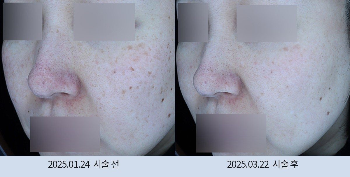 스노우의원 다산점 색소 시술 전후